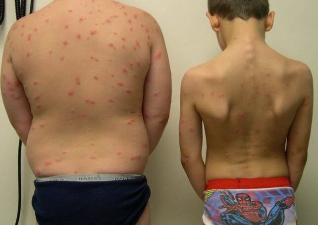 Rash on the skin with worms