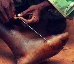 Parasite at a person's feet