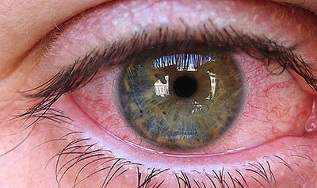 reasons for the appearance of parasites in the eyes of humans